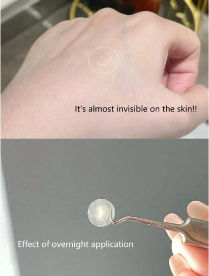 Acne Pimple Patch (400pcs)