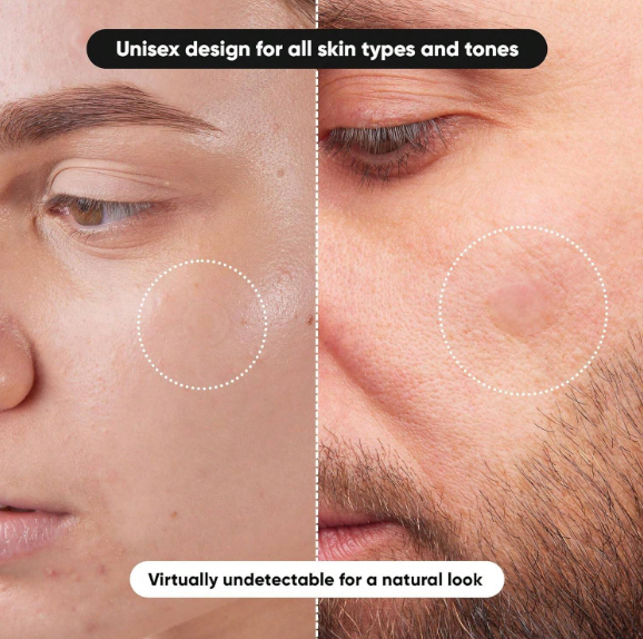 Acne Pimple Patch (400pcs)